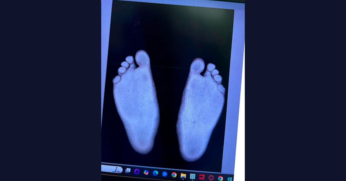 Escaneo de la huella plantar en un control de seguimiento