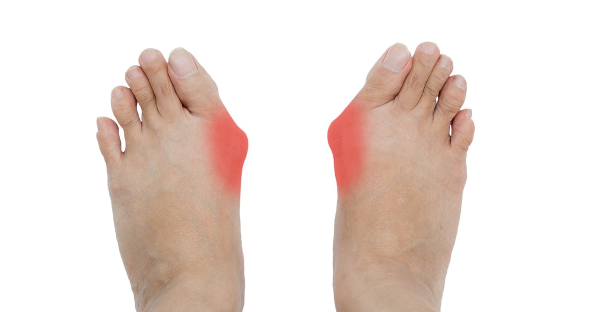 Pies con dolor en la zona del juanete (hallux valgus) por sobrecarga del antepié