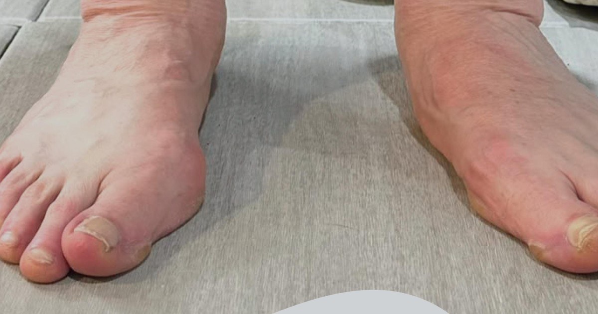 Vista frontal de los pies de un paciente con pie plano y caída del arco