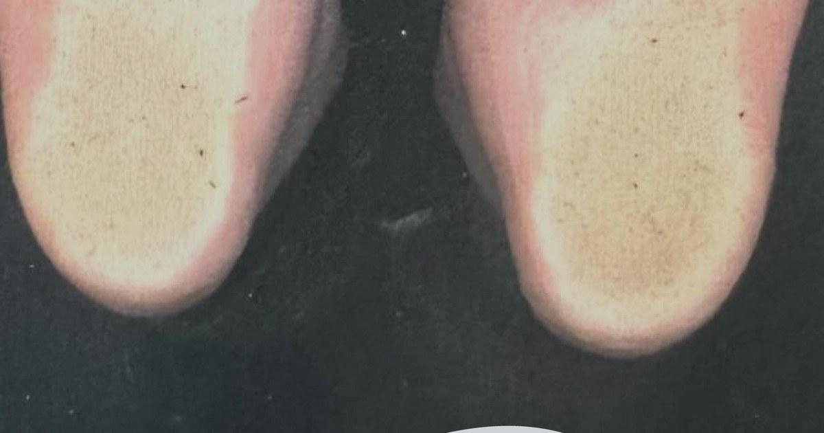 Plantas de los pies de un paciente mostrando las zonas de apoyo y de carga