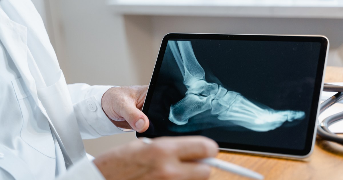 Radiografía de pie revisada por un especialista para valorar espolón calcáneo